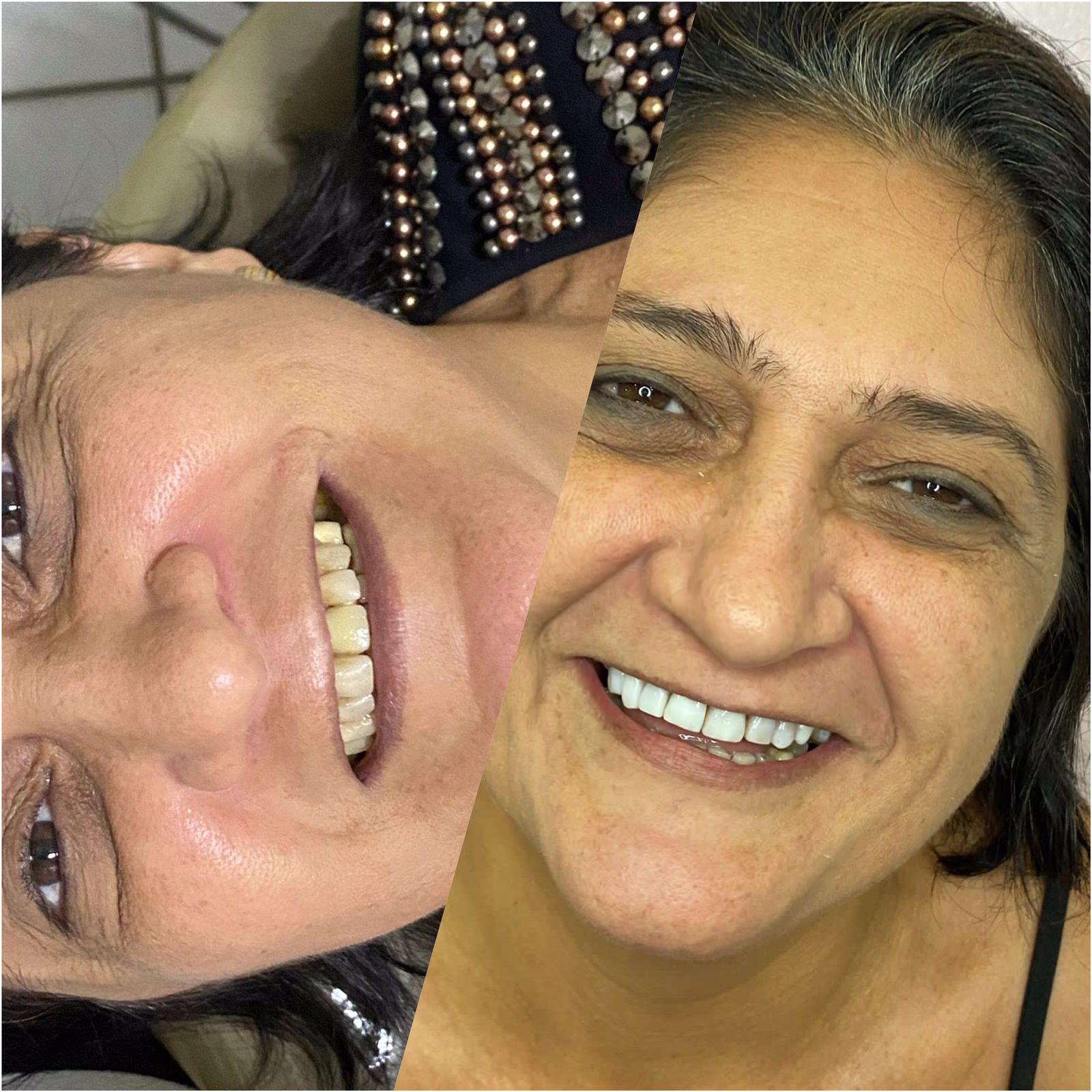 Facetas de Resina – UnicDental Med Fortaleza