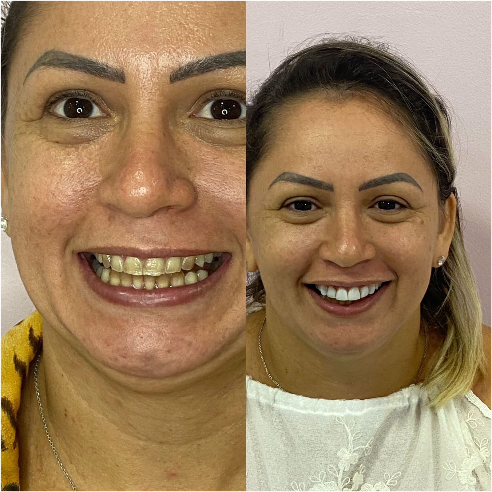 Facetas de Resina – UnicDental Med Fortaleza
